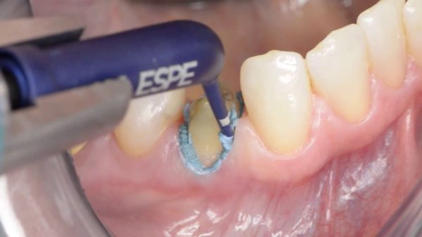 3M ESPE Astringent Retraction Paste Capsule - Dentalstall India