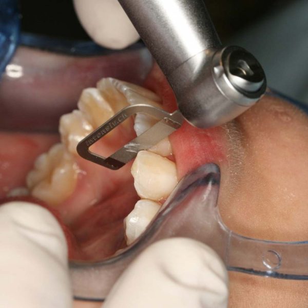 Waldent Orthodontic Inter-Proximal Reduction (IPR) Kit - Dentalstall India