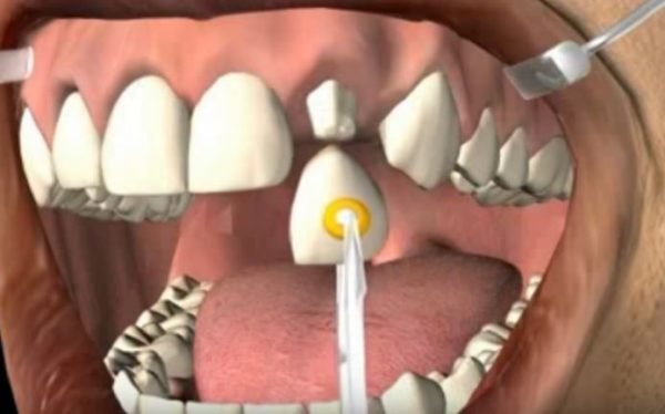 GDC Temporary Crown Removing Plier CR4562 - Dentalstall India
