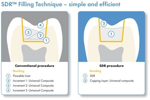 Dentsply SDR Flowable Bulk Filling Material - Dentalstall India