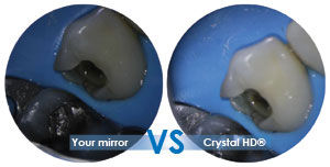 Zirc Crystal HD Mirrors - Dentalstall India