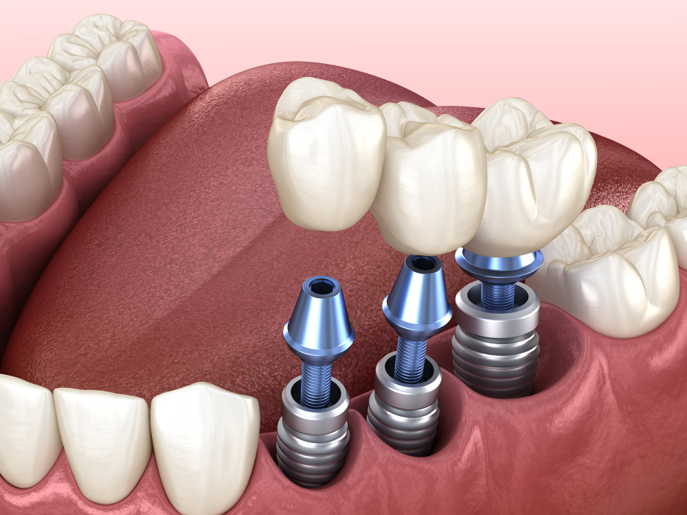 Dental Implants A Comprehensive Guide