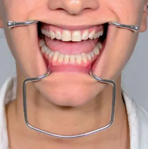 API Metallic Cheek Retractor - Dentalstall India