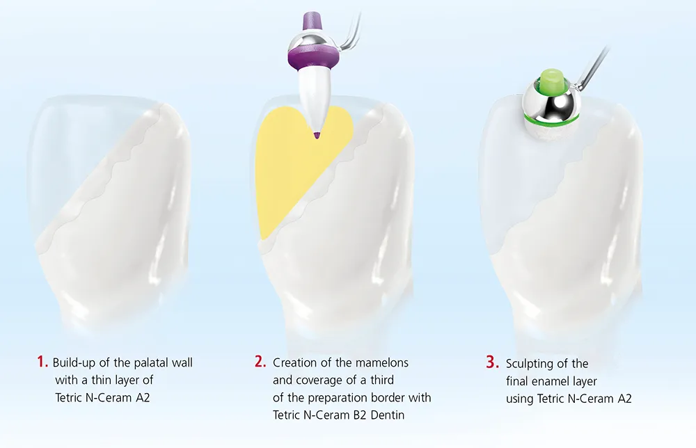Ivoclar Tetric N Ceram Composite Kit & Refills - Dentalstall India Ivoclar Tetric N Ceram Composite Kit & Refills - Dentalstall India