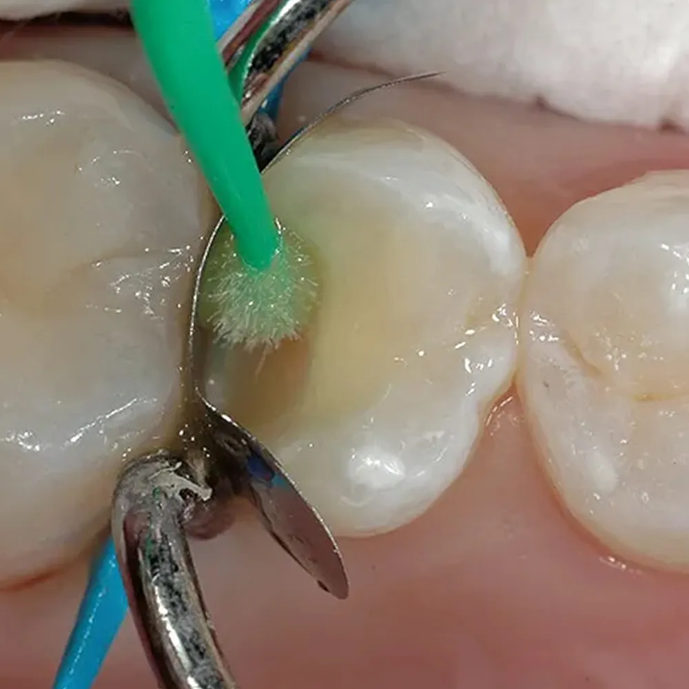Septodont Secure 5th Generation Bond - Dentalstall India Septodont Secure 5th Generation Bond - Dentalstall India