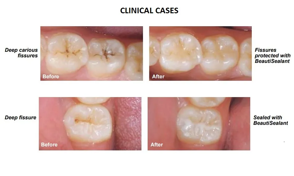 Shofu BeautiSealant Pit & Fissure Sealant - Dentalstall India Shofu BeautiSealant Pit & Fissure Sealant - Dentalstall India
