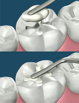 Shofu Beautifil Bulk Restorative Composite - Dentalstall India Shofu Beautifil Bulk Restorative Composite - Dentalstall India