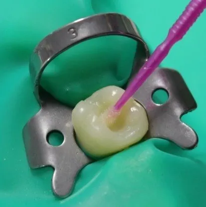 Septodont Secure 5th Generation Bond - Dentalstall India Septodont Secure 5th Generation Bond - Dentalstall India