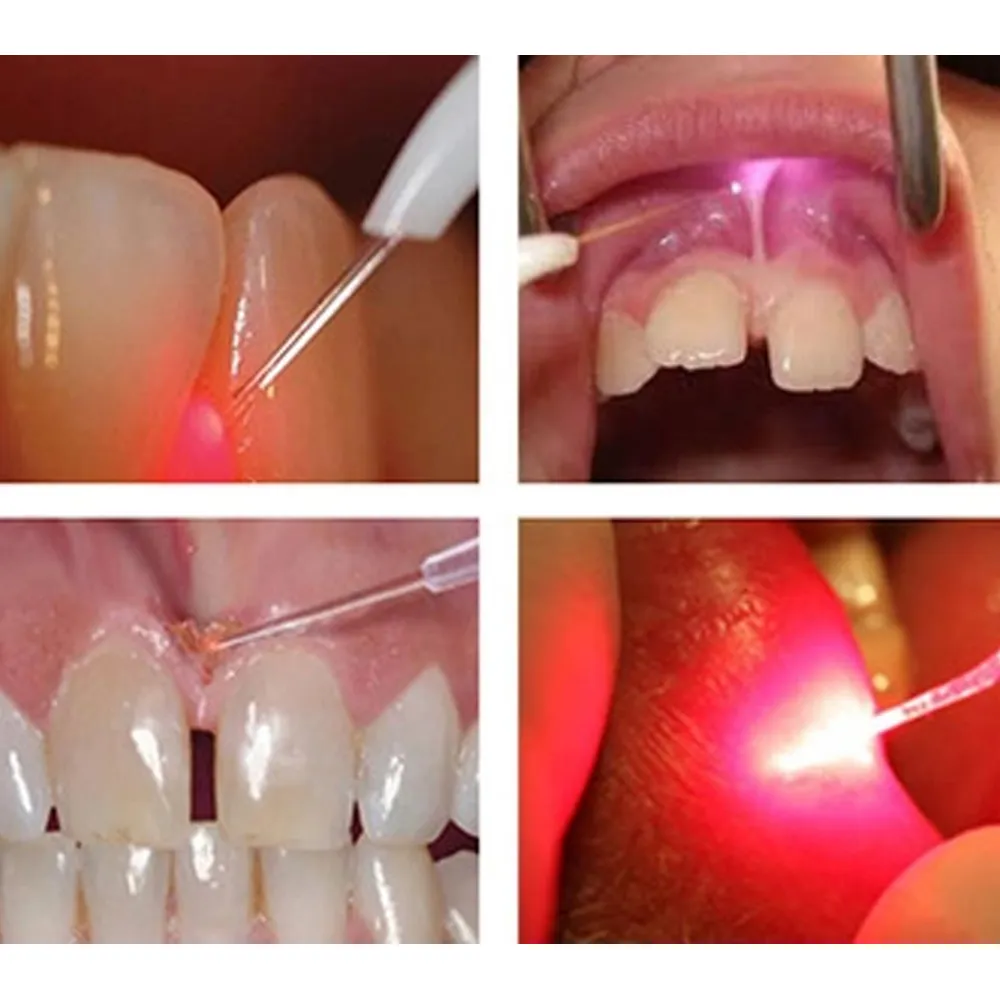 Woodpecker LX16 Diode Laser Tips (Pack of 3) - Dentalstall India Woodpecker LX16 Diode Laser Tips (Pack of 3) - Dentalstall India