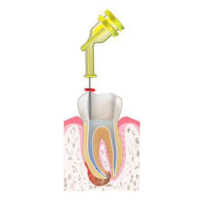 Ultradent Navi Tip 31 Gauge with Double Sideport Irrigator Tip (Pack of 20) - Dentalstall India Ultradent Navi Tip 31 Gauge with Double Sideport Irrigator Tip (Pack of 20) - Dentalstall India