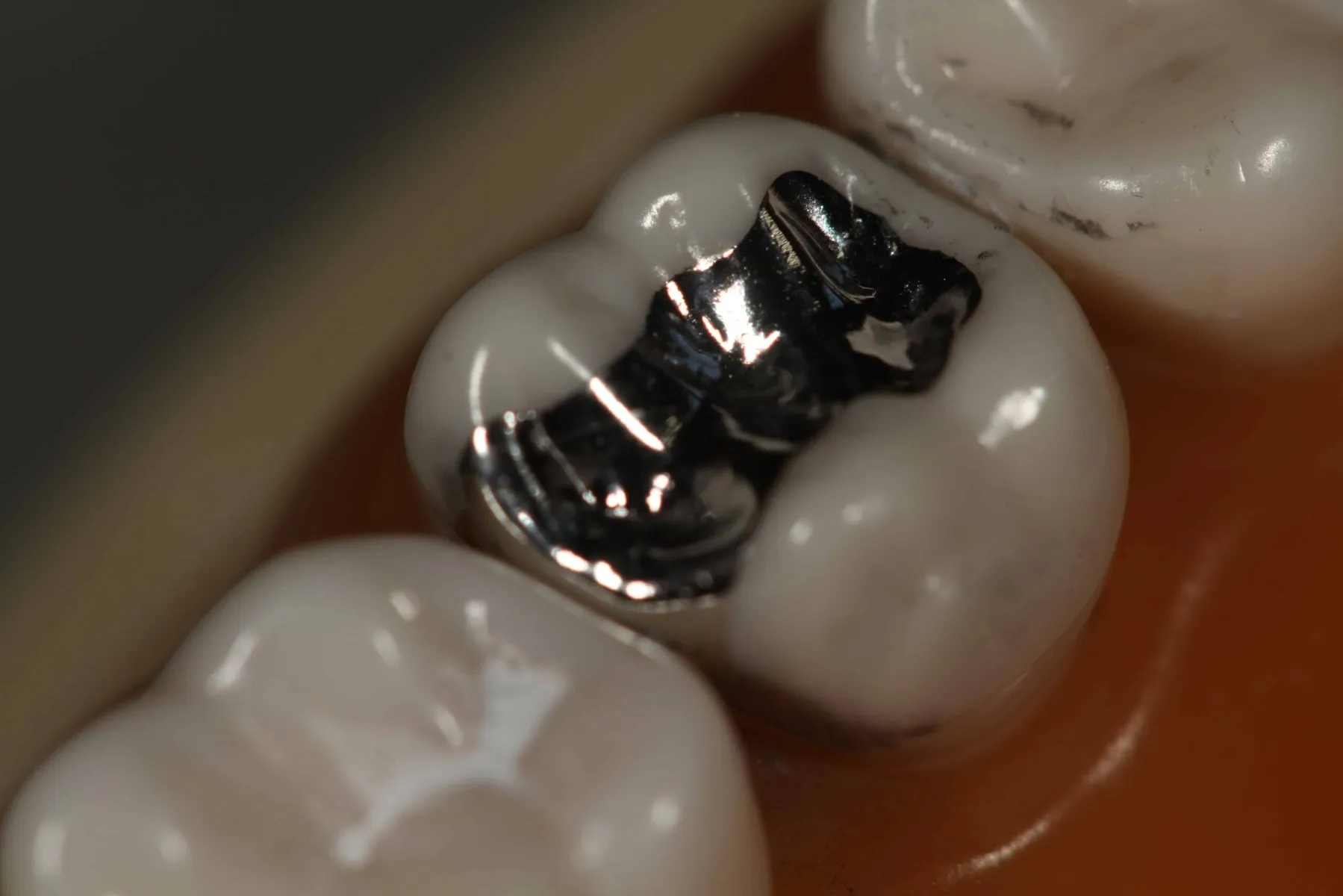 Dpi Fine Grain Dental Silver Alloy - Dentalstall India Dpi Fine Grain Dental Silver Alloy - Dentalstall India