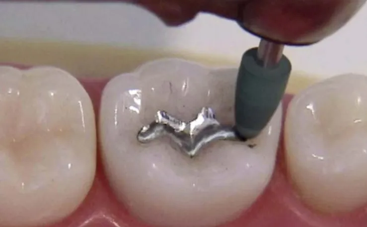 Shofu Amalgam Polishing Kit Fg/Ca - Dentalstall India Shofu Amalgam Polishing Kit Fg/Ca - Dentalstall India