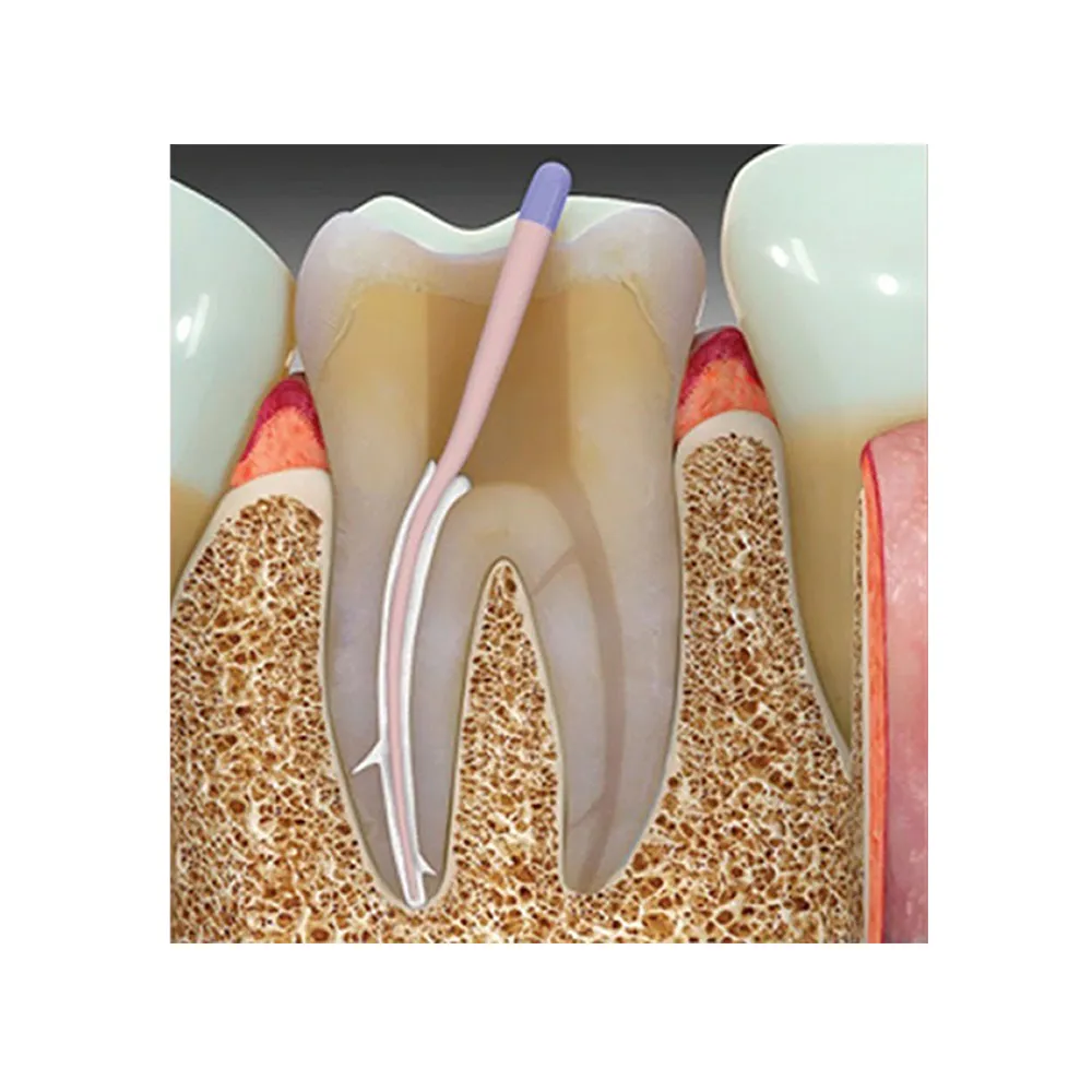 Woodpecker KP Root Injectable Root Canal Sealer - Dentalstall India Woodpecker KP Root Injectable Root Canal Sealer - Dentalstall India