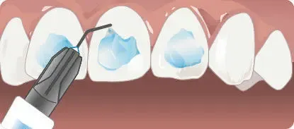 D-Tech Embrace LC Orthodontic Bonding Kit - Dentalstall India D-Tech Embrace LC Orthodontic Bonding Kit - Dentalstall India