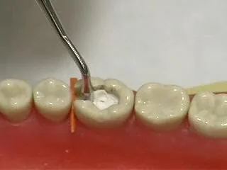 Medicept Stic Temporary Cavity Filling Material - Dentalstall India Medicept Stic Temporary Cavity Filling Material - Dentalstall India