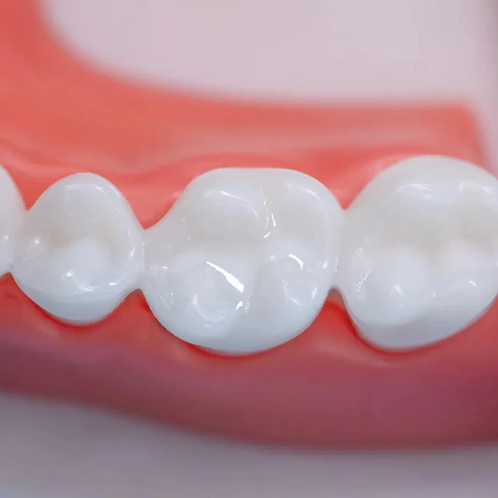 Vincismile Proseal F Pit & Fissure Sealant - Dentalstall India Vincismile Proseal F Pit & Fissure Sealant - Dentalstall India