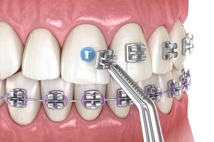 D-Tech Embrace LC Orthodontic Bonding Kit - Dentalstall India D-Tech Embrace LC Orthodontic Bonding Kit - Dentalstall India