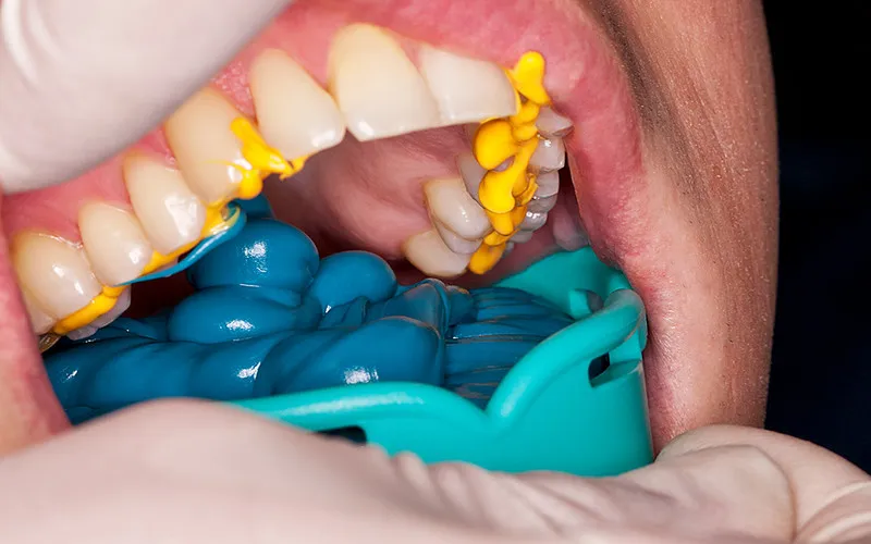 DMG Honigum Putty (Short Expiry 10-2025) - Dentalstall India DMG Honigum Putty (Short Expiry 10-2025) - Dentalstall India