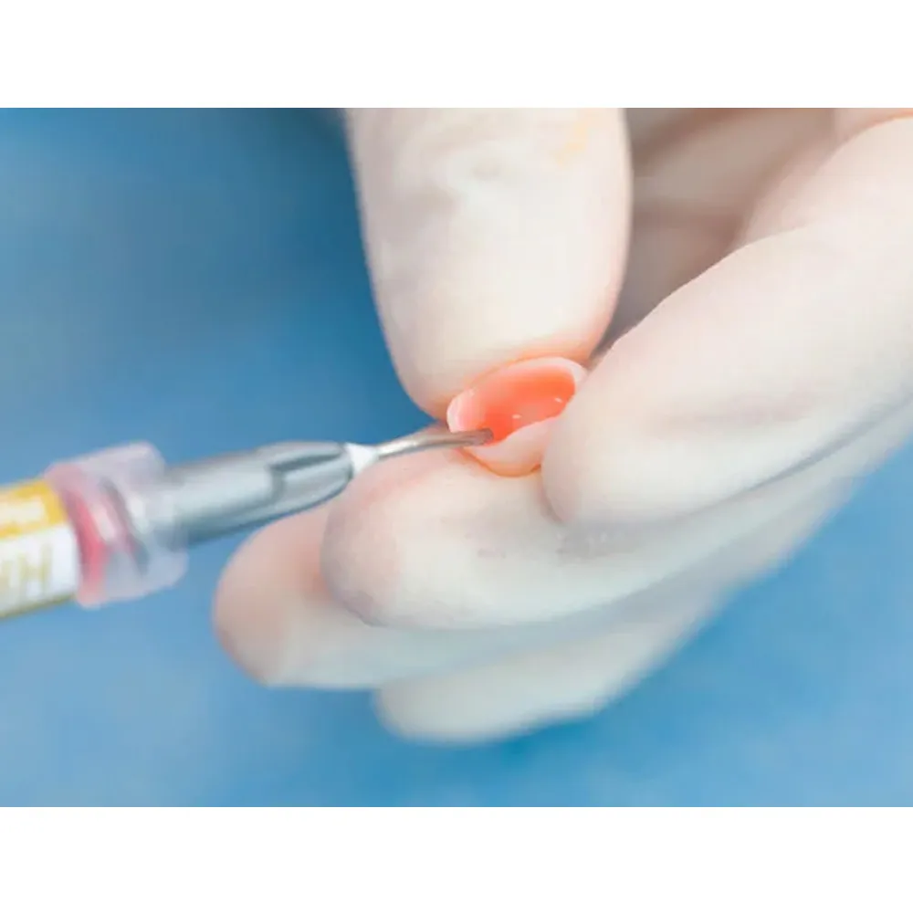 Vincismile HF-Etchant Hydrofluoric Acid Etching Gel - Dentalstall India Vincismile HF-Etchant Hydrofluoric Acid Etching Gel - Dentalstall India