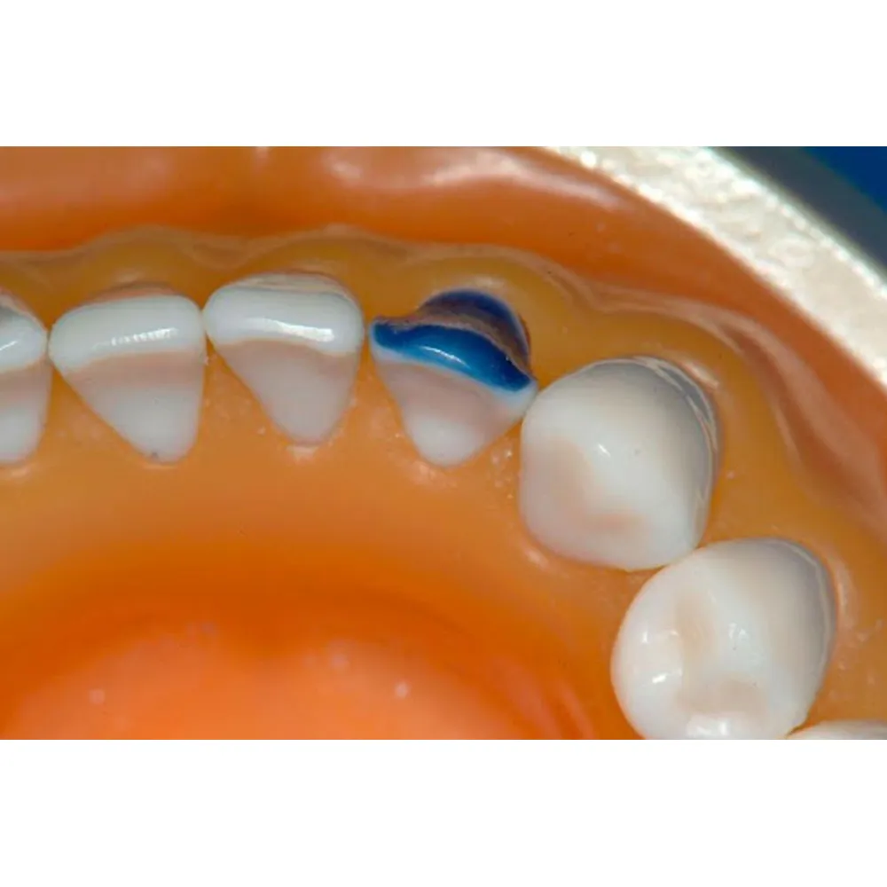 Maarc Inlay/Onlay Wax Sticks - Dentalstall India Maarc Inlay/Onlay Wax Sticks - Dentalstall India