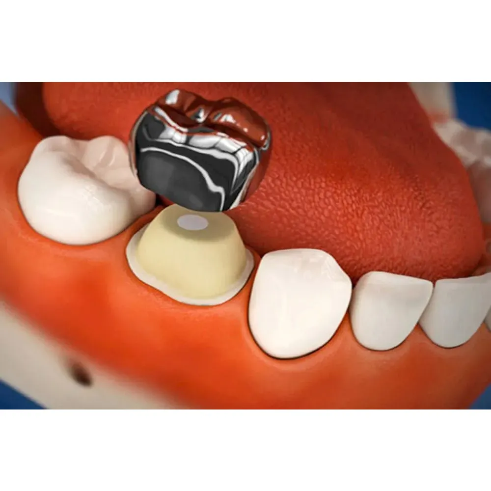 Oro SS Little Crown Primary Molar Kits - Dentalstall India Oro SS Little Crown Primary Molar Kits - Dentalstall India