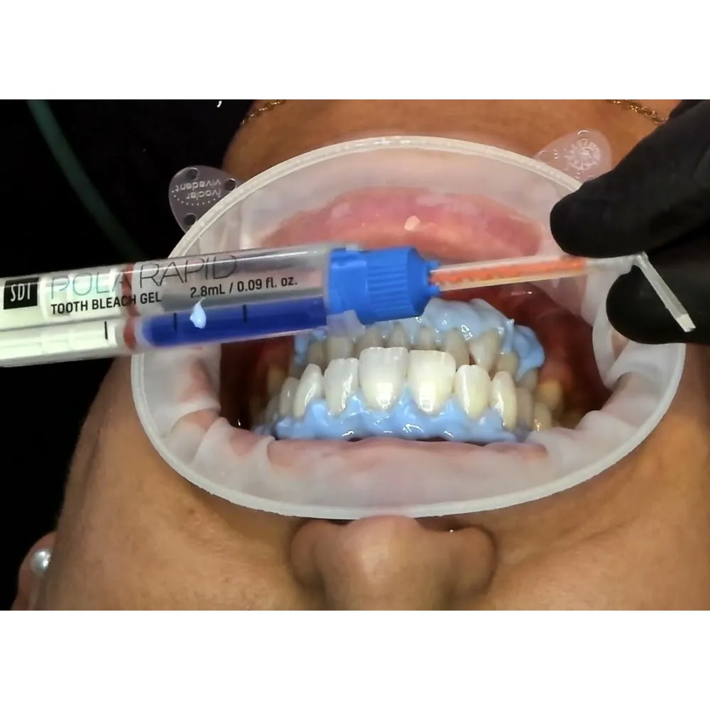 SDI Pola Rapid Advanced Tooth Whitening System - Dentalstall India SDI Pola Rapid Advanced Tooth Whitening System - Dentalstall India