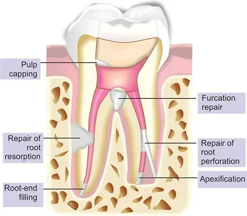 Maarc Ceraset MTA Putty - Dentalstall India Maarc Ceraset MTA Putty - Dentalstall India
