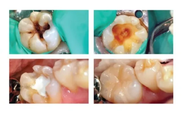 Maarc Ceraset MTA Putty - Dentalstall India Maarc Ceraset MTA Putty - Dentalstall India