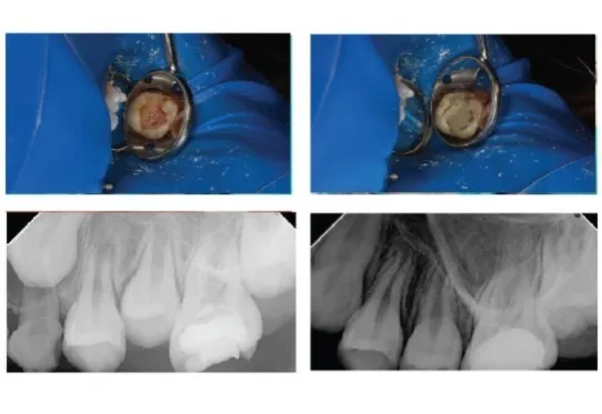 Maarc Ceraset MTA Putty - Dentalstall India Maarc Ceraset MTA Putty - Dentalstall India