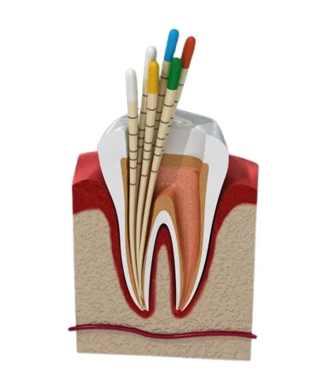 Neoendo Gutta Percha Points 4% (Length Marked) - Dentalstall India Neoendo Gutta Percha Points 4% (Length Marked) - Dentalstall India