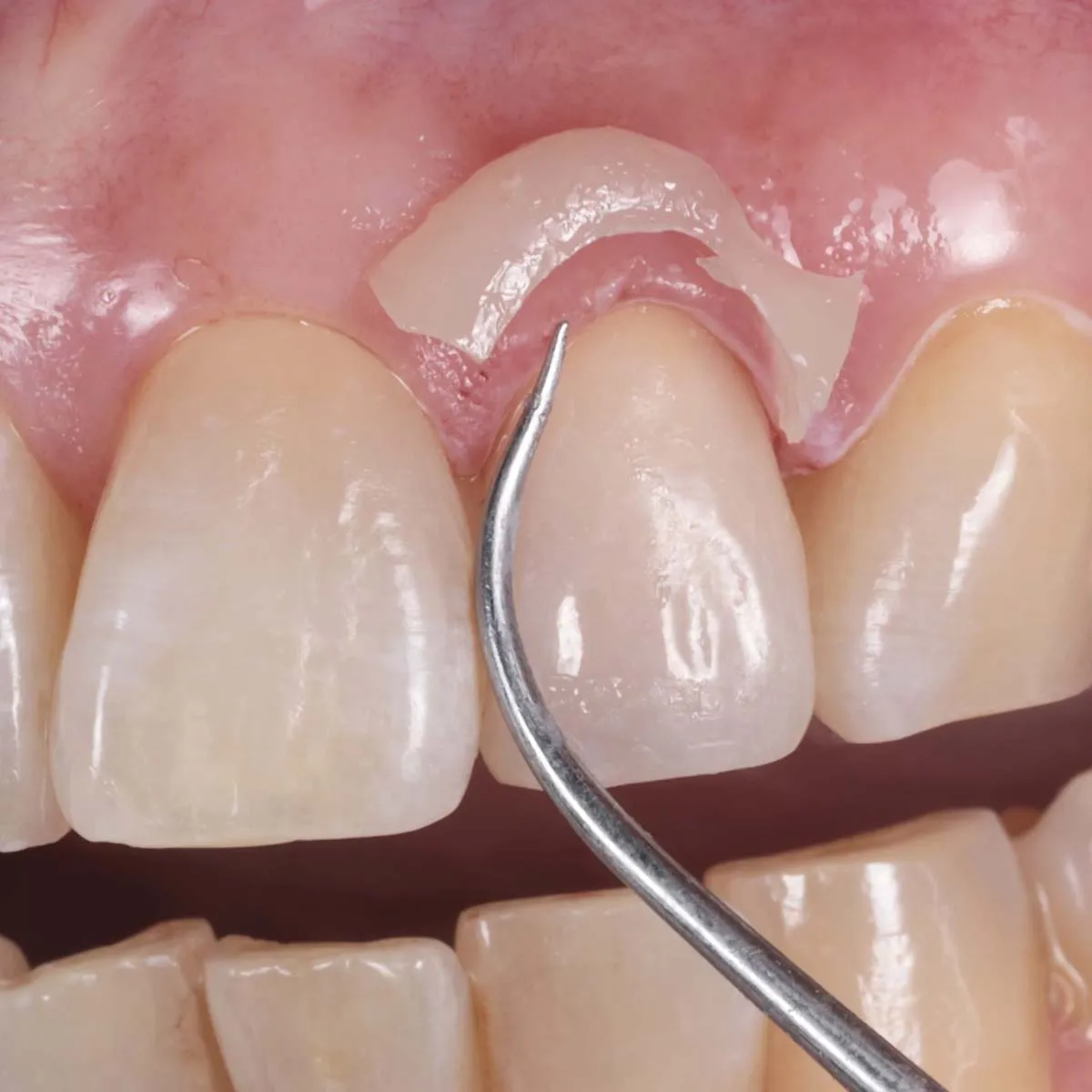 Ammdent URC Dual Cure Resin Cement - Dentalstall India Ammdent URC Dual Cure Resin Cement - Dentalstall India